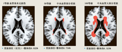 韩国标准科学研究院开发世界首个“脑梗塞地图”